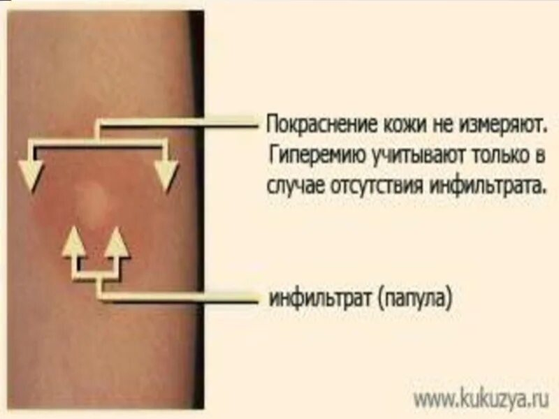 Реакция манту у ребенка что значит. Нормальная папула манту. нормы размеров папулы манту у детей.