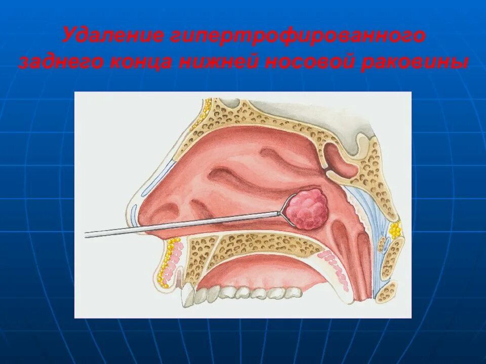 Гипертрофический ринит нижней носовой раковины. Гипертрофический ринит ринит. Гипертрофия слизистой носовых раковин. Гипертрофия слизистой оболочки носовых. Острый катаральный ринит