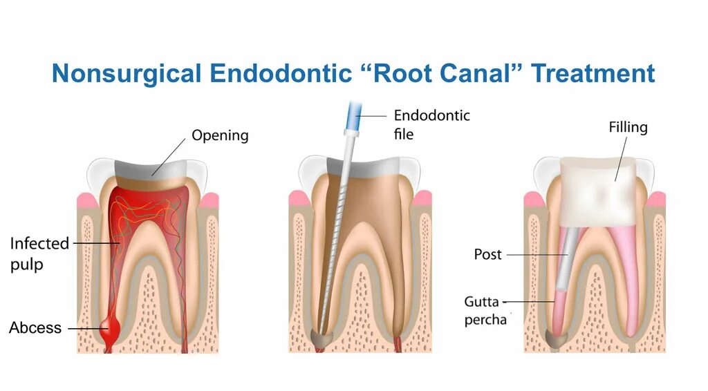 Root canal. Endodontic картинка.