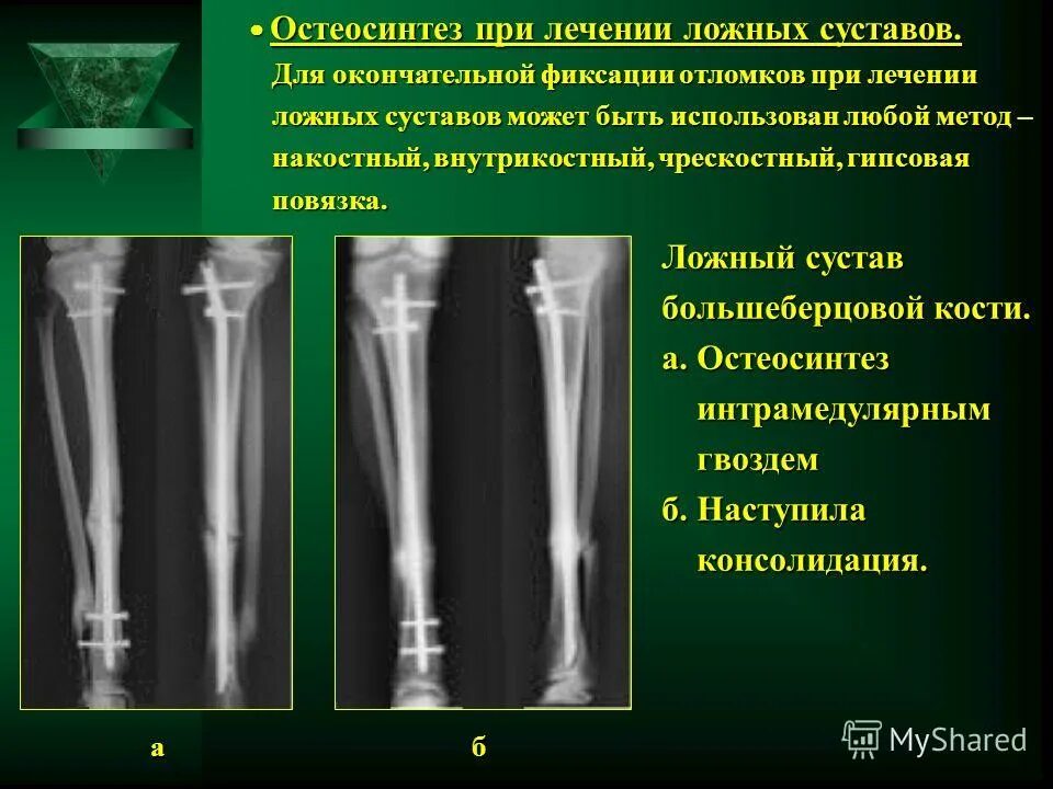 Остеосинтез бедренной большеберцовой кости. Ложный сустав большеберцовой кости. Остеосинтез большеберцовой кости штифтом. Остеосинтез большеберцовой кости стержнем.