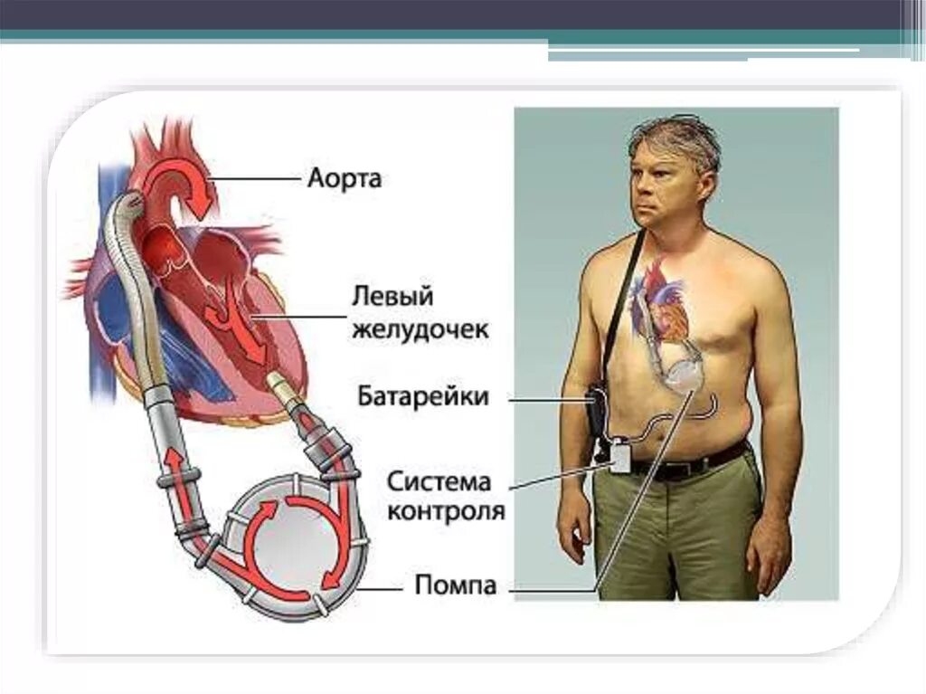 Механический левый желудочек сердца. Искусственный левый желудочек. Искусственный левый желудочек сердца. Механические желудочки сердца.
