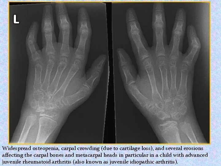 Ревматоидного артрита у детей клинические. Рентген кистей при ревматоидном артрите. Ювенильный ревматоидный артрит рентген кисти. Ревматоидный артрит у детей рентген. Ревматоидный полиартрит кисти рентген.