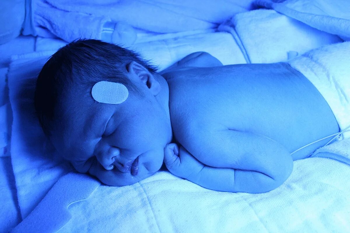 Желтуха новорожденных отзывы. Желтушка у новорожденных 287. Фототерапия новорожденного. Желтушка у новорожденных фототерапия. Фототерапия для новорожденных при желтухе.