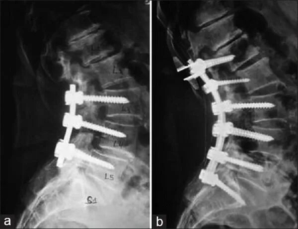 Кейдж имплант шейного отдела. Остеосинтез позвоночника l1 транспедикулярной. Остеосинтез позвоночника рентгенограмма. Передний спондилодез l5. Операция на позвоночник с металлоконструкцией инвалидность