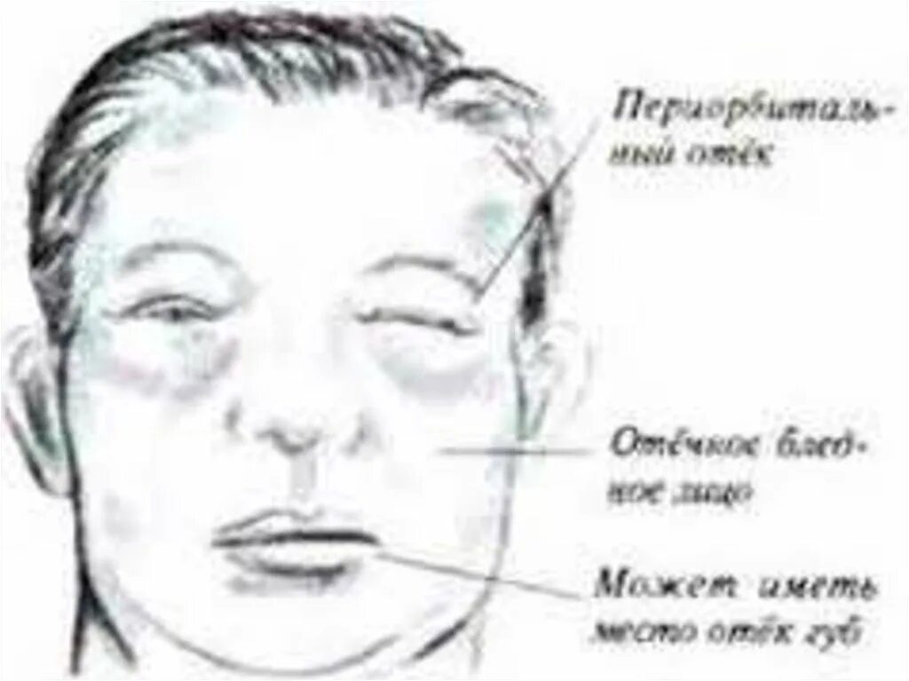 Отеки при остром гломерулонефрите с нефротическим синдромом:. Отечный синдром при нефротическом синдроме.