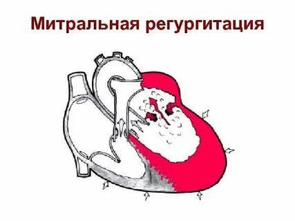 Дисфункция клапана