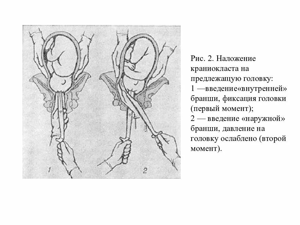 Запущенное положение плода. Плодоразрушающая операция декапитация. Плодоразрушающие операции краниотомия. Плодоразрушающие операции в акушерстве классификация. Краниотомия плода декапитация.