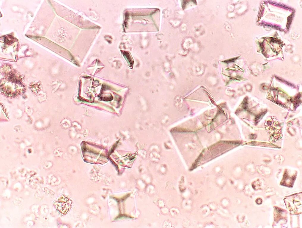 Оксалат кальция в моче повышен. Оксалаты кальция в моче под микроскопом. Кристаллы оксалата кальция в моче. Оксалаты кальция в моче микроскопия. Оксалаты в моче микроскопия.
