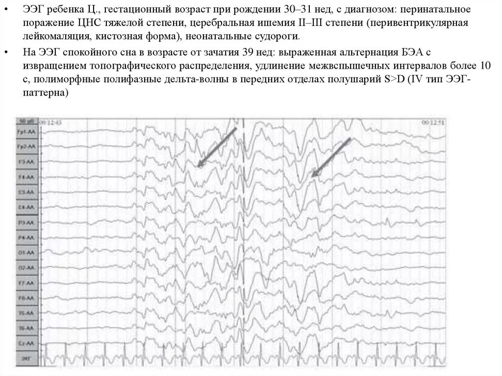 Церебральная ишемия у новорожденного 2. ЭЭГ при гидроцефалии. Полифазные волны на ЭЭГ. ЭЭГ при ишемическом инсульте. ЭЭГ при судорогах у новорожденных.