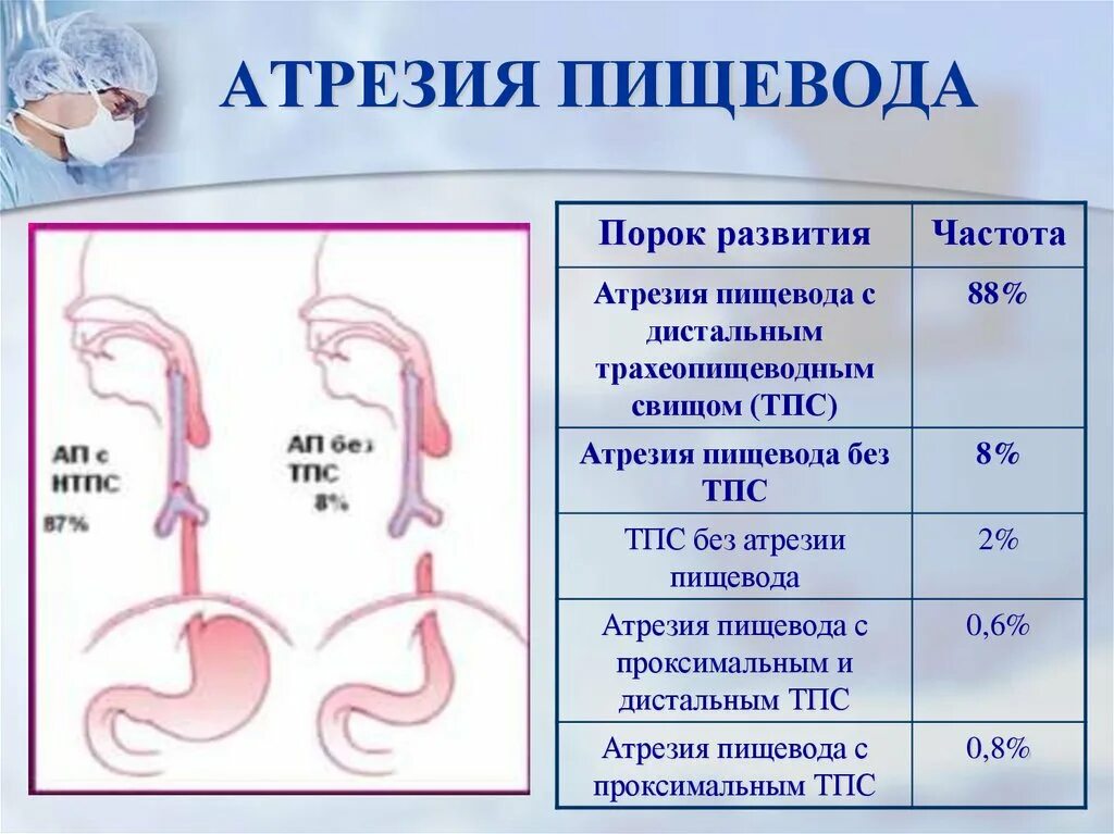 Отсутствие пищевода. Атрезия пищевода классификация. Классификация атрезии пищевода у детей. Атрезия пищевода с трахеопищеводным свищом.