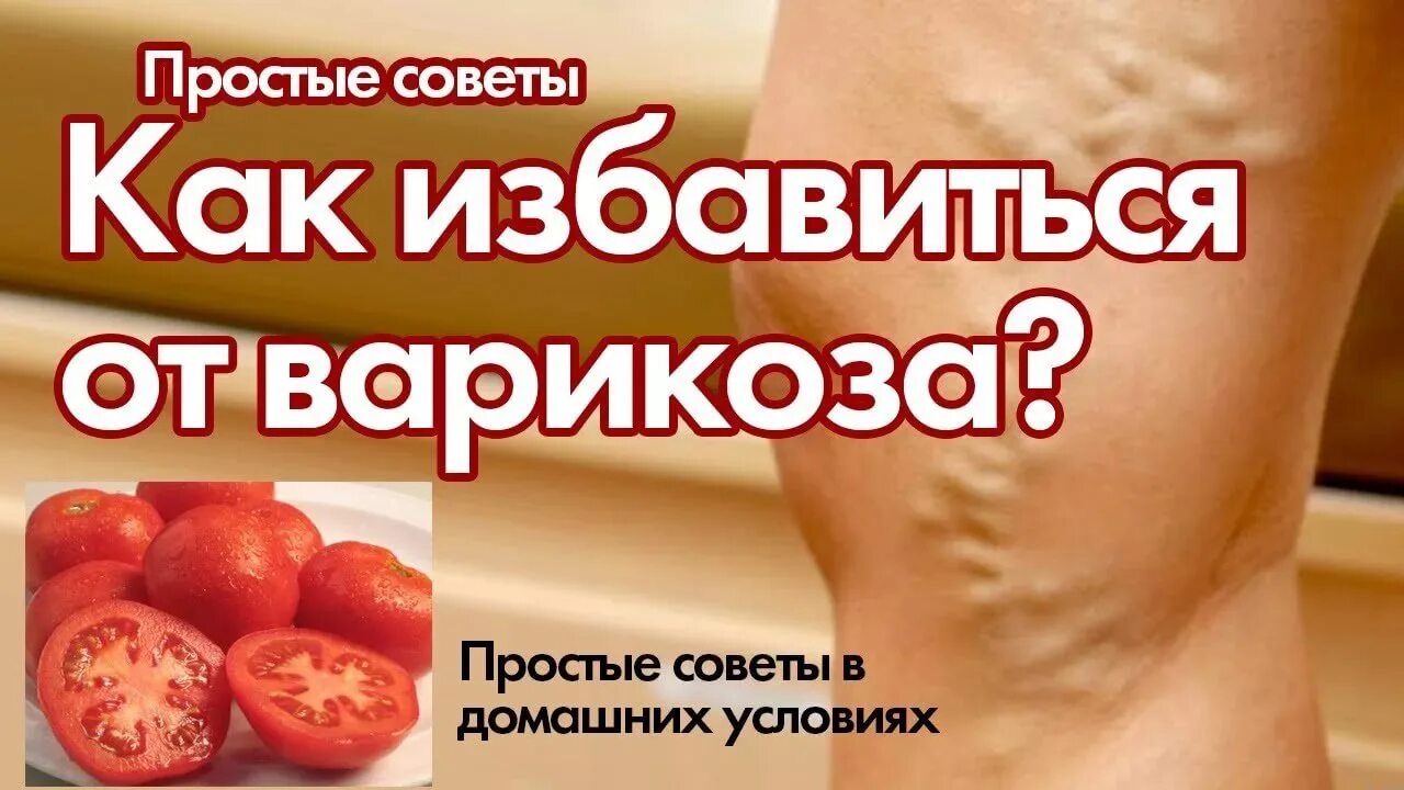 Народные средства от варикозного расширения вен. Народные средства от варикоза вен. Средство от варикоза на ногах. Народное средство от варикоза на ногах. Народные средства от варикоза.