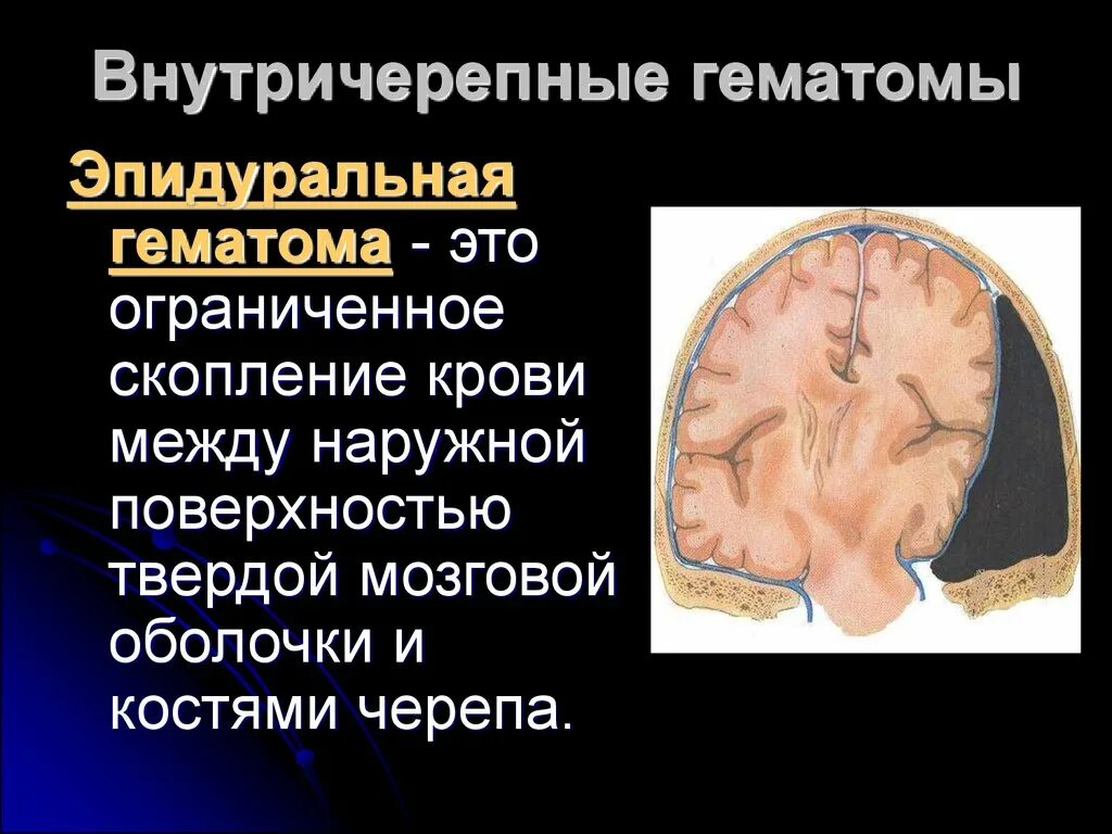 Черепно мозговые гематомы. Субдуральная и эпидуральная гематома. Внутричерепная гематома. Гематома в головном мозге. Хроническая эпидуральная гематома.