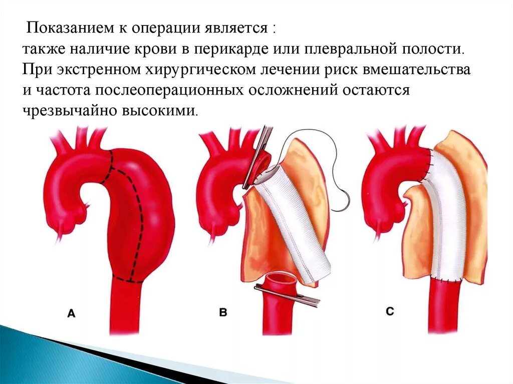 Аневризма показания к операции. Расслаивающая аневризма аорты операция. Протезирование аорты операция. Аневризма аорты сердца операция. Кардиохирургия аневризма корня аорты.
