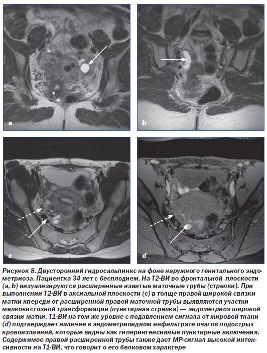 Трубы маточные гидросальпинкс мрт. Эндометриоз маточных труб мрт. Эндометриоз и гидросальпинкс. Расширение маточной трубы мрт. Гидросальпинкс лечение операции