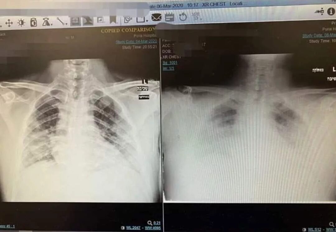 снимки легких при коронавирусе. ли рентген коронавирус. коронавирус пневмония рентген. Covid 19 рентген снимок легких. ли рентген коронавирус.