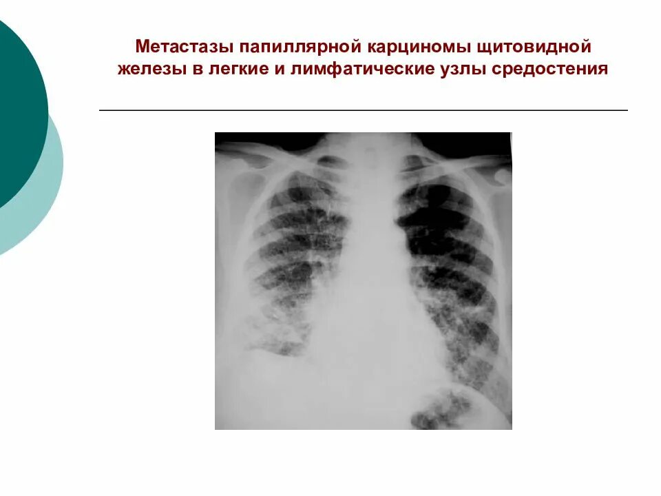 Метастазы щитовидной железы в легкие. Метастазы в лимфоузлы средостения. метастазы опухоли щитовидной железы. метастазирование щитовидной железы. метастазы щитовидной железы в легких.