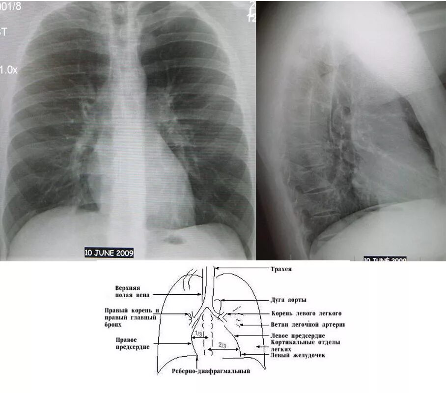 Синусы лёгких на рентгенограмме. Синусы на рентгене легких. Рентген грудной клетки боковая проекция. Легочные синусы на рентгене. Размер левого легкого