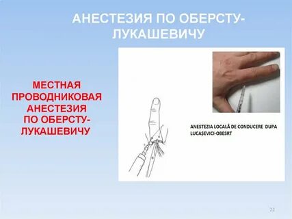 Анестезия по лукашевичу оберсту