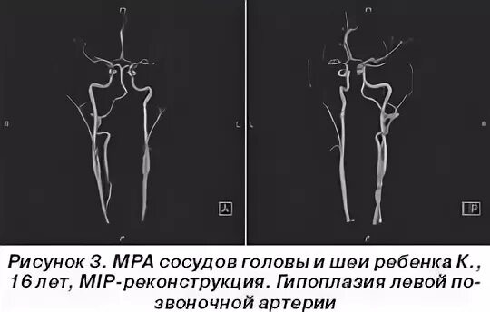 Гипоплазия правой артерии мозга. Гипоплазия позвоночной артерии. Гипоплазия позвоночной артерии кт. Гипоплазия правой позвоночной артерии. Гипоплазия правой артерии шеи.