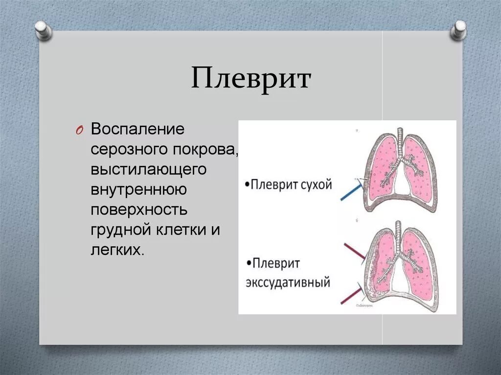 Плевральные осложнения. Сухой и выпотной плеврит. Двухсторонний выпотной плеврит. Заболевание плеврит легкого. Заболевание плевры легких.