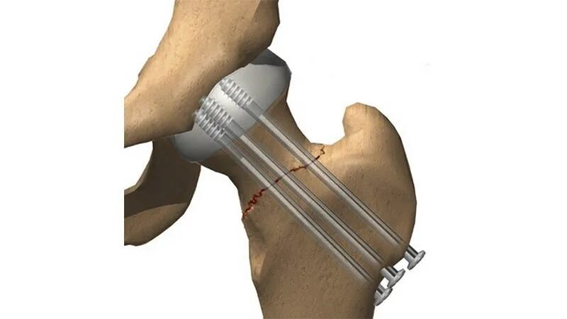Шейка бедра операция отзывы. Остеосинтез перелома шейки бедра канюлированными винтами. Перелом бедра остеосинтез. Перелом шейки бедра остеосинтез. Остеосинтез надколенника винтами.