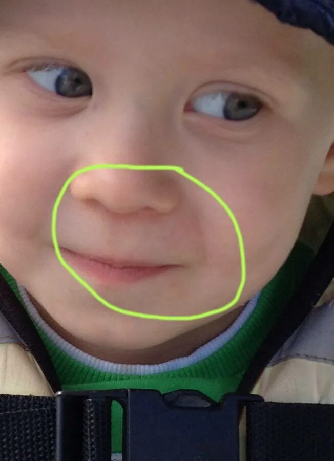 Цианоз носогубного треугольника. Синий носогубный треугольник. Носогубный треугольник у ребенка. Синюшность носогубного треугольника.