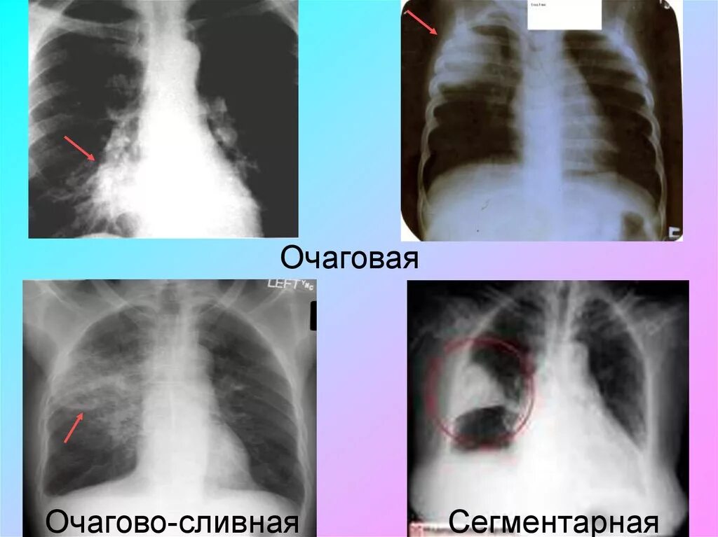 Что значит сегментарная пневмония. Очагово сливная пневмония рентген. очагово сливная пневмония у детей рентген. сливно очаговая пневмония. очаговая сегментарная крупозная пневмония.
