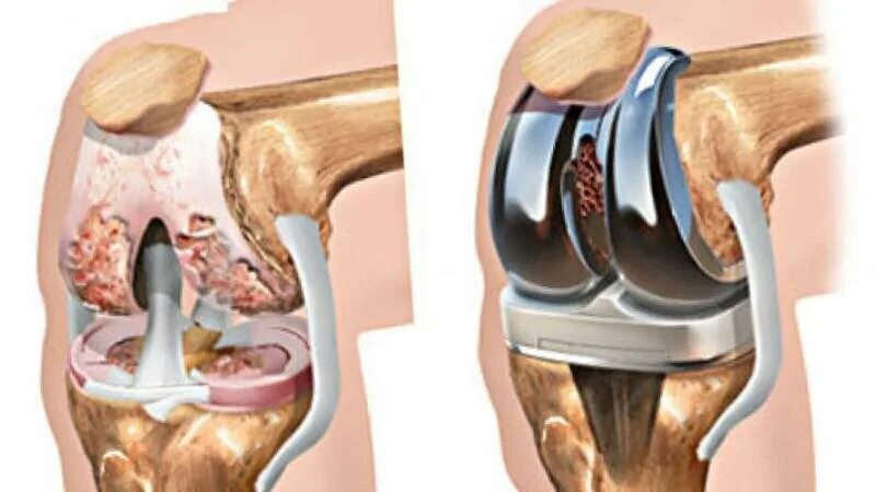 Асептический некроз коленного кости. Тотальное эндопротезирование коленного сустава. Асептический некроз коленного сустава. Гангрена тазобедренного сустава. Ростов замена коленного сустава