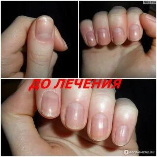 Лак после грибка ногтей