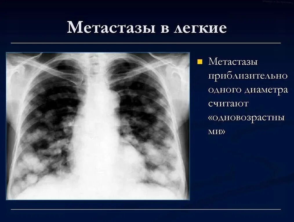 Метастазы симптомы и признаки. Метастазы в легких рентген. метастатическое поражение легких рентген. метастатические опухоли легких.