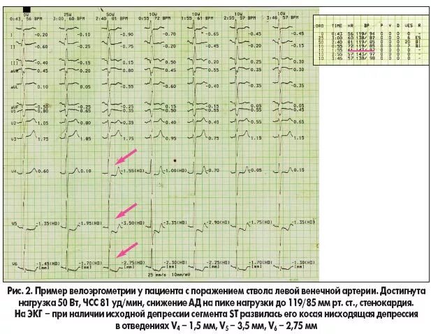 Изменения на ЭКГ при стенокардии напряжения. ЭКГ при стенокардии напряжения. Изменения на ЭКГ при нестабильной стенокардии. ЭКГ при стенокардии фото.