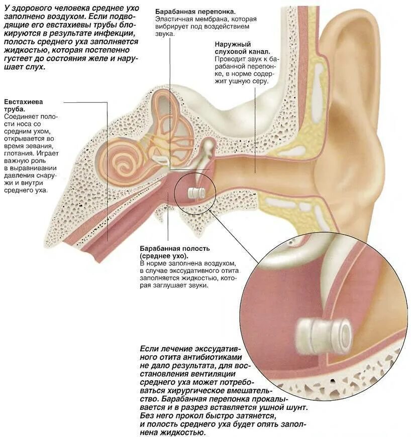 Шунты в уши ребенку. Экссудативный отит перепонка. Экссудативный средний отит шунт. Шунтирование барабанной перепонки. Шунт барабанной перепонки.