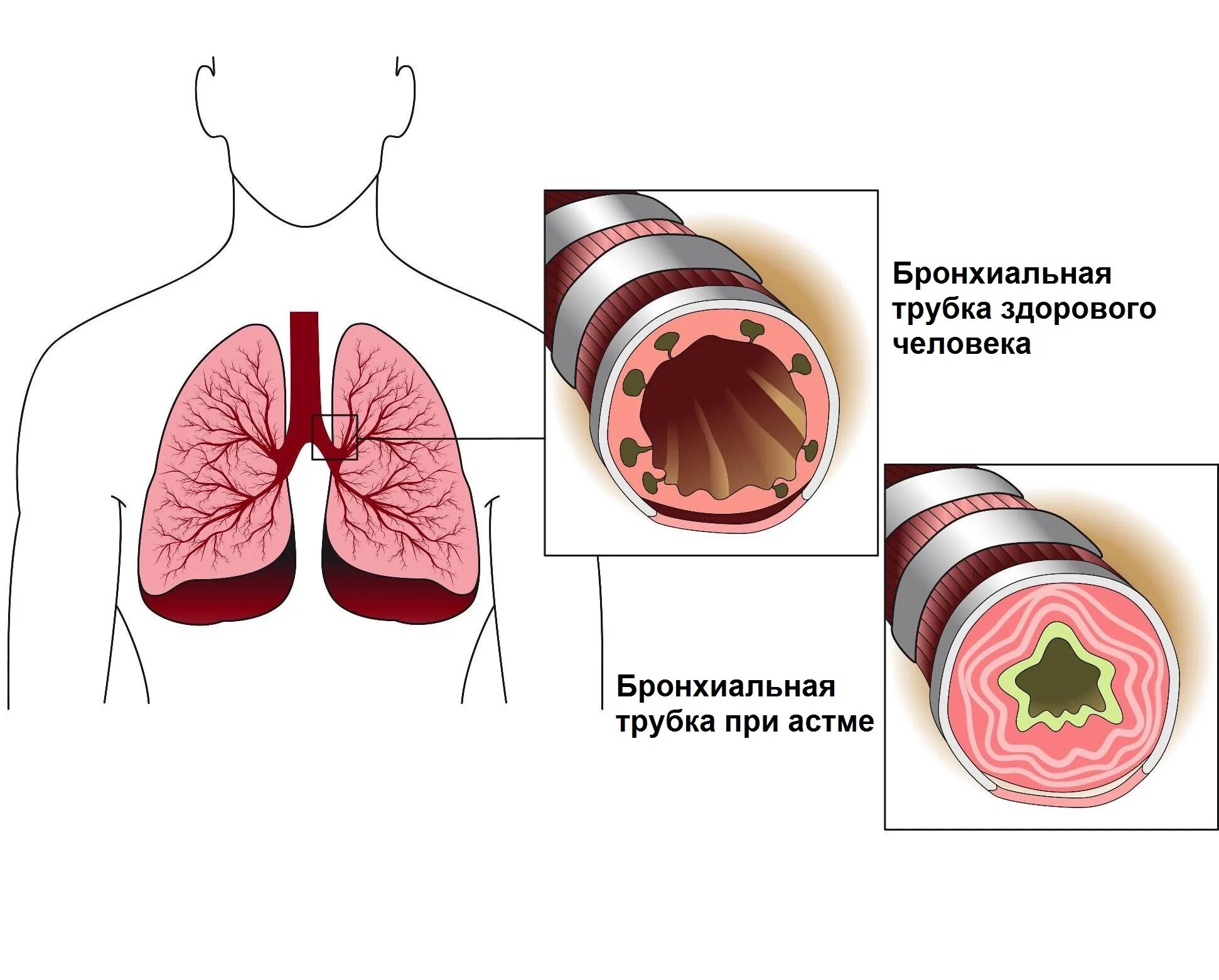 Бронхит заразен или. Приступ бронхиальной астмы. Бронхи при бронхиальной астме. Бронх астма. Легкие больного бронхиальной астмой.