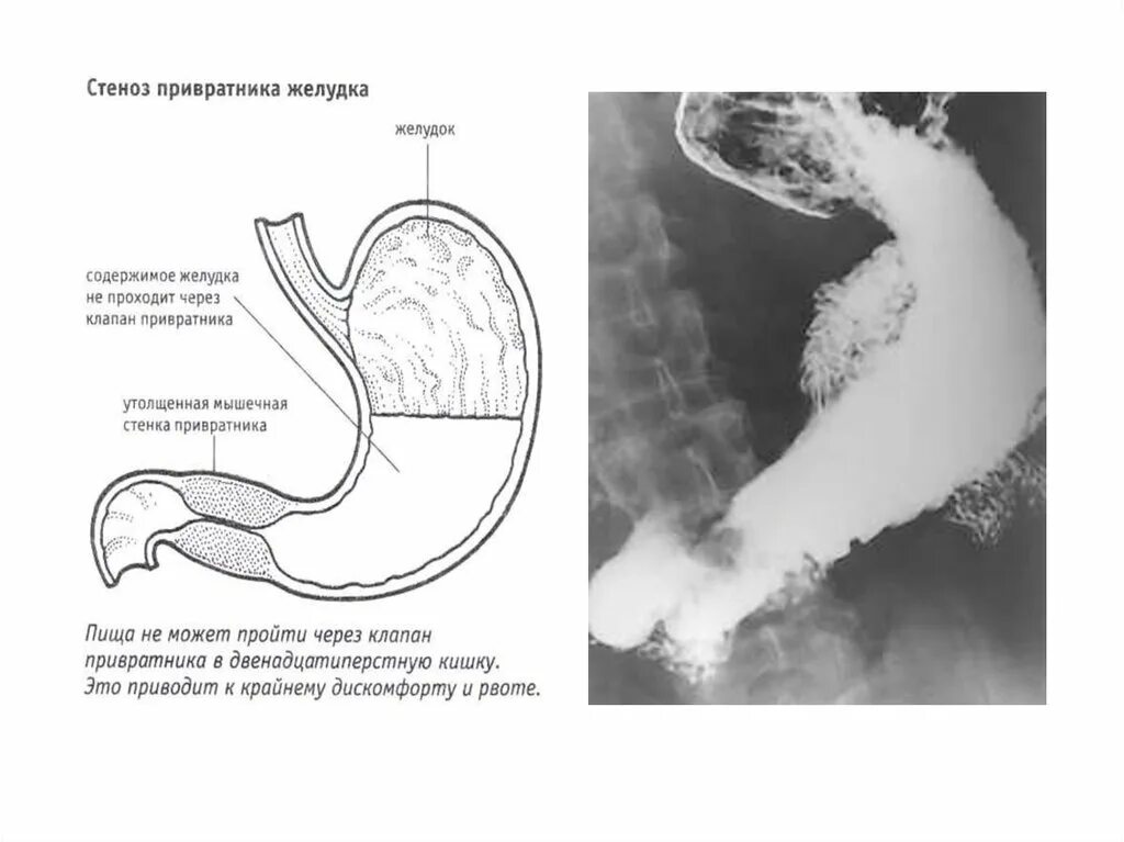 Кто такой привратник. Язва привратника желудка рентген. Пилородуоденальный стеноз эндоскопия. Язвенный стеноз привратника рентген. Стеноз привратника язвы желудка.