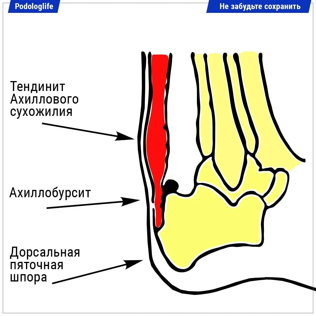 Тендинит пяточного ахиллова сухожилия. Тендинопатия ахиллова сухожилия. Воспаление ахиллова сухожилия на пятке. Строение ахиллова сухожилия.