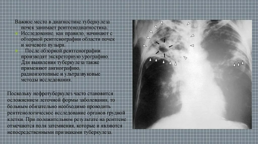 Туберкулез мочевой системы