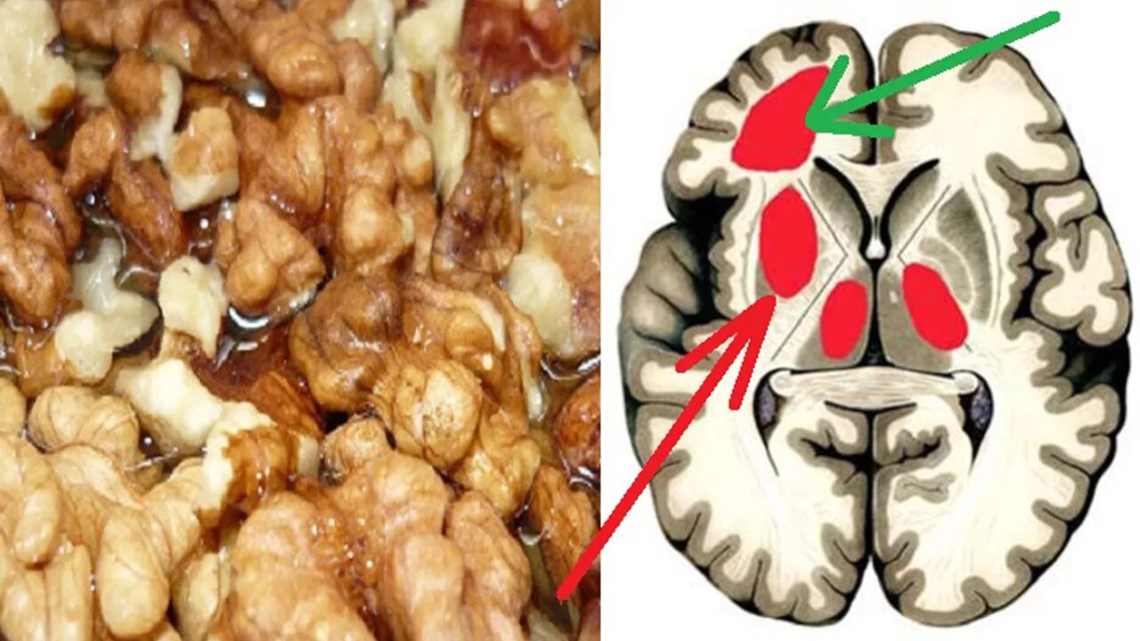 Очистка сосудов головы. Очищение сосудов головного мозга. Грецкий орех и мозг. Очищение сосудов грецким орехом. Очищение сосудов мозга кровеносных головного мозга.