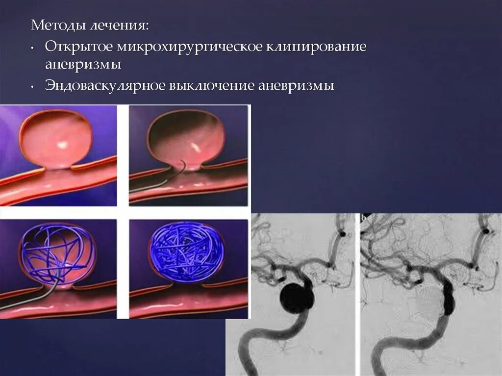 Аневризма головного мозга эндоваскулярным. Эндоваскулярная операция аневризмы головного. Эндоваскулярная эмболизация аневризмы головного мозга. Микрохирургическое клипирование аневризмы. Эндоваскулярная хирургия аневризм артерий головного мозга.