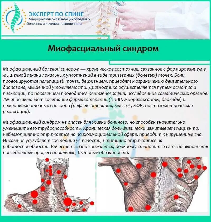 Миофасциальный синдром пояснично крестцового симптомы и лечение. Трапециевидная мышца спины триггерные точки. миофасциальный синдром цервикалгия. миофасциальный синдром крестцового отдела. миофасциальный болевой синдром триггерные точки.