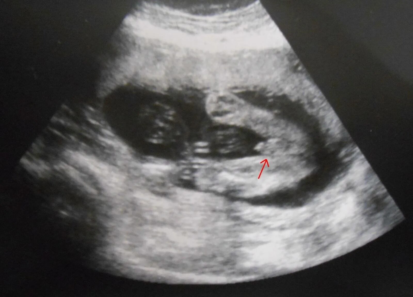 узи 17 недель беременности девочка или мальчик. узи на 22 неделе беременности пол девочка. девочка на узи снизу в 20 недель. узи ребенка 20 недель девочка. 20 недель беременности узи пол ребенка мальчик.