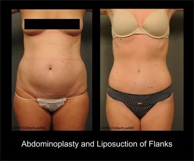 Abdominoplasty Mini & Full Before and After Photos