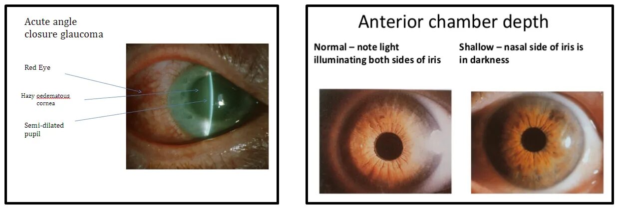 Закрытоугольная глаукома. Острый приступ закрытоугольной глаукомы. Глаукома латынь