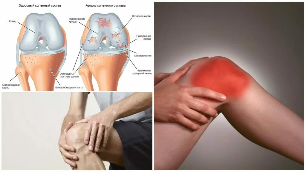 Изменения в коленных суставах. Гонартроз коленного сустава клиника. Хрящевая ткань коленного сустава. Деформирующий остеоартроз коленного сустава. Артроз коленного сустава симптомы.