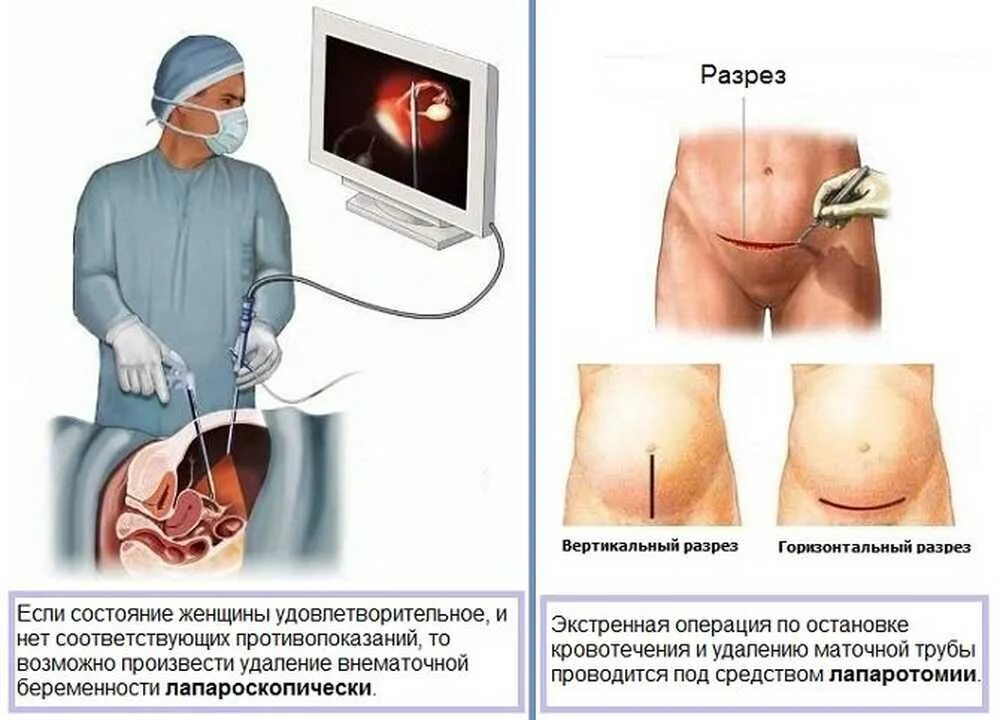 Лапароскопия через сколько можно беременеть