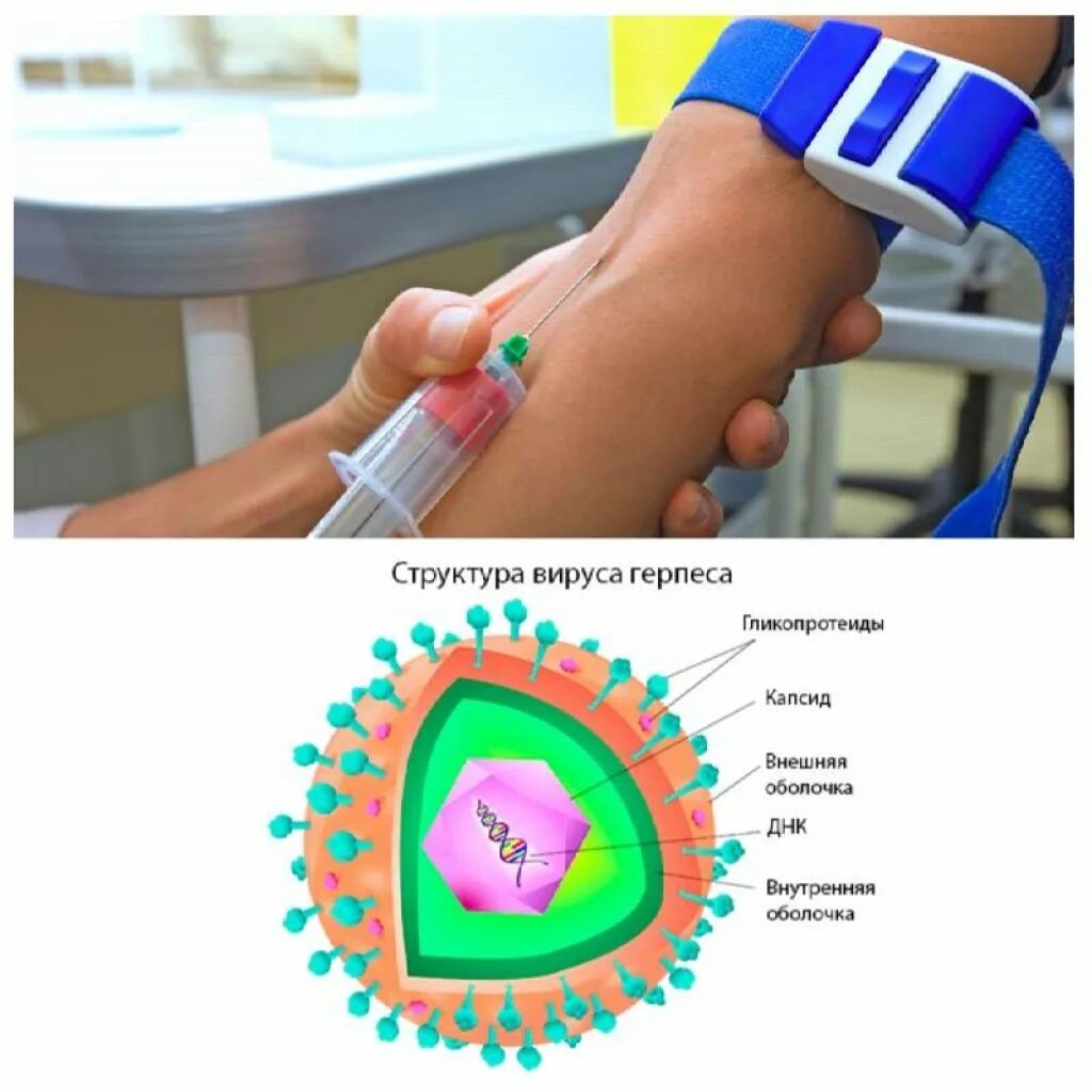 Herpes simplex 2 igg. Вирус простого герпеса 1 и 2 типа. Вирус простого герпеса 2 типа. Диагностика герпесвируса.