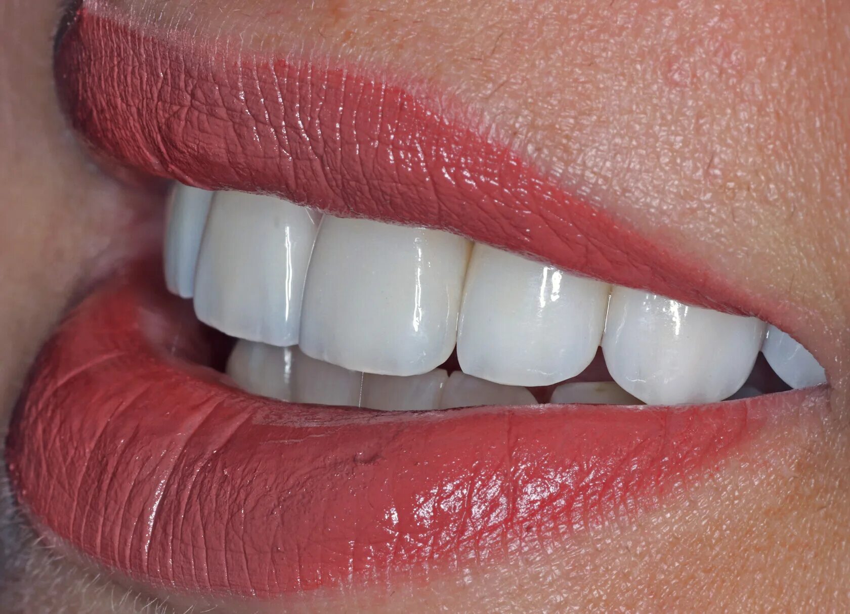 металлокерамика никель хром. металлокерамической коронки (никель/хром). мостовидный протез металл керамика. коронка металлокерамическая (каркас кхс). металлокерамика с фасеткой.