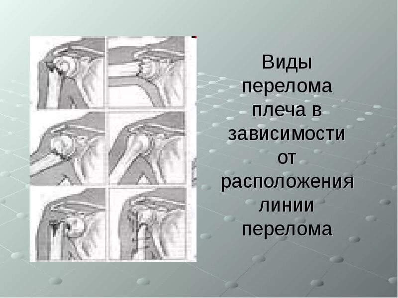 Виды перелома плеча