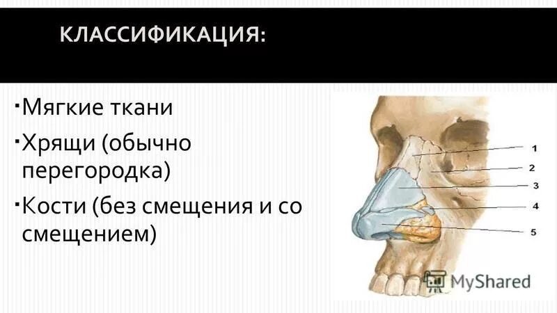 Опухоль из хрящевой ткани