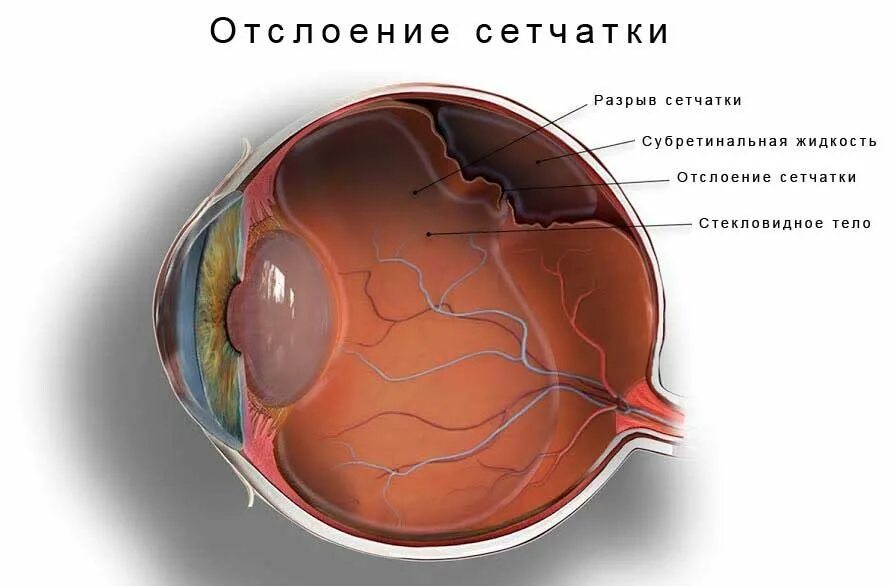 Регматогенная отслойка сетчатки. Помутнение стекловидного тела. Отслойка сетчатки офтальмология. Задняя гиалоидная мембрана стекловидного тела.