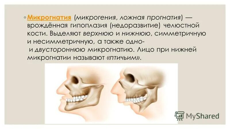 Микрогения. Микрогения верхней челюсти. Прогнатия верхней и нижней челюсти. Микрогнатия нижней челюсти.